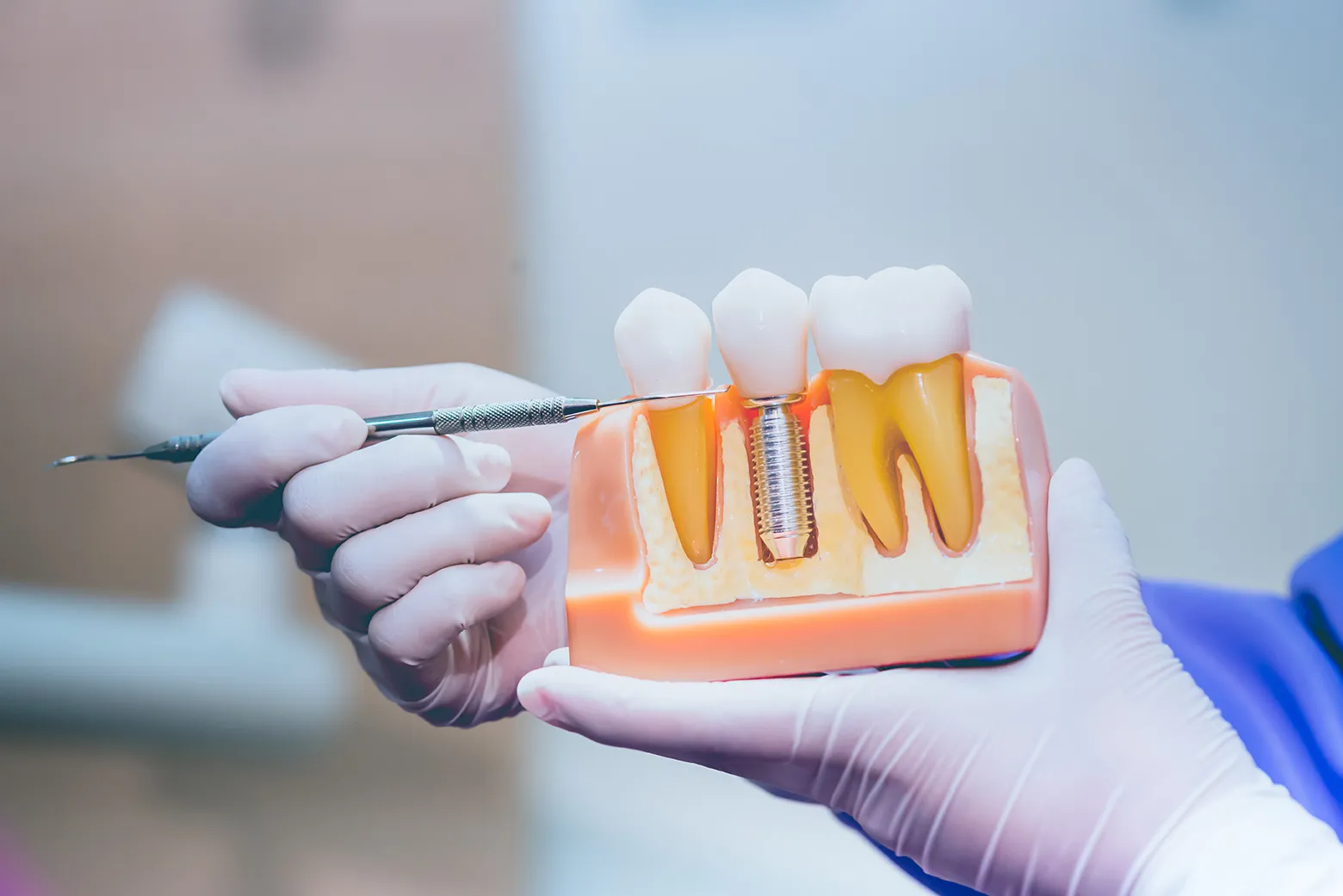Veneers