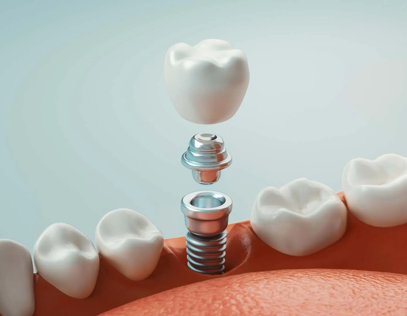 3D rendering of a dental implant showing a crown above metal abutment and screw in gums.