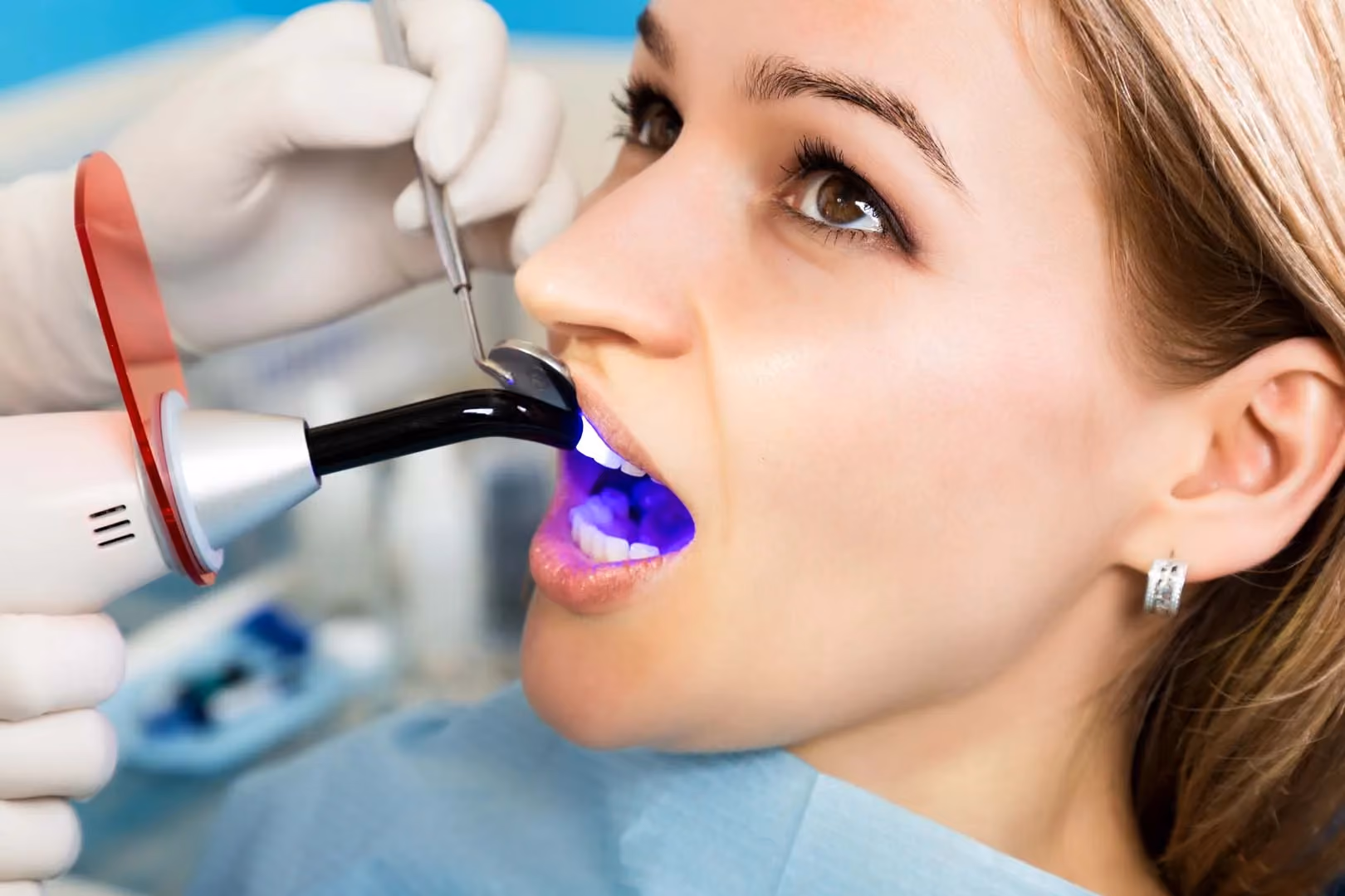 Dental Fillings