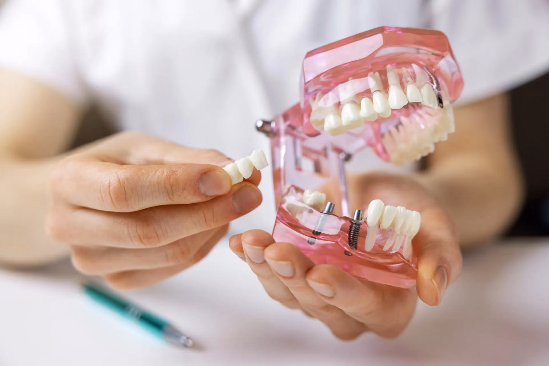 Dental Bridges