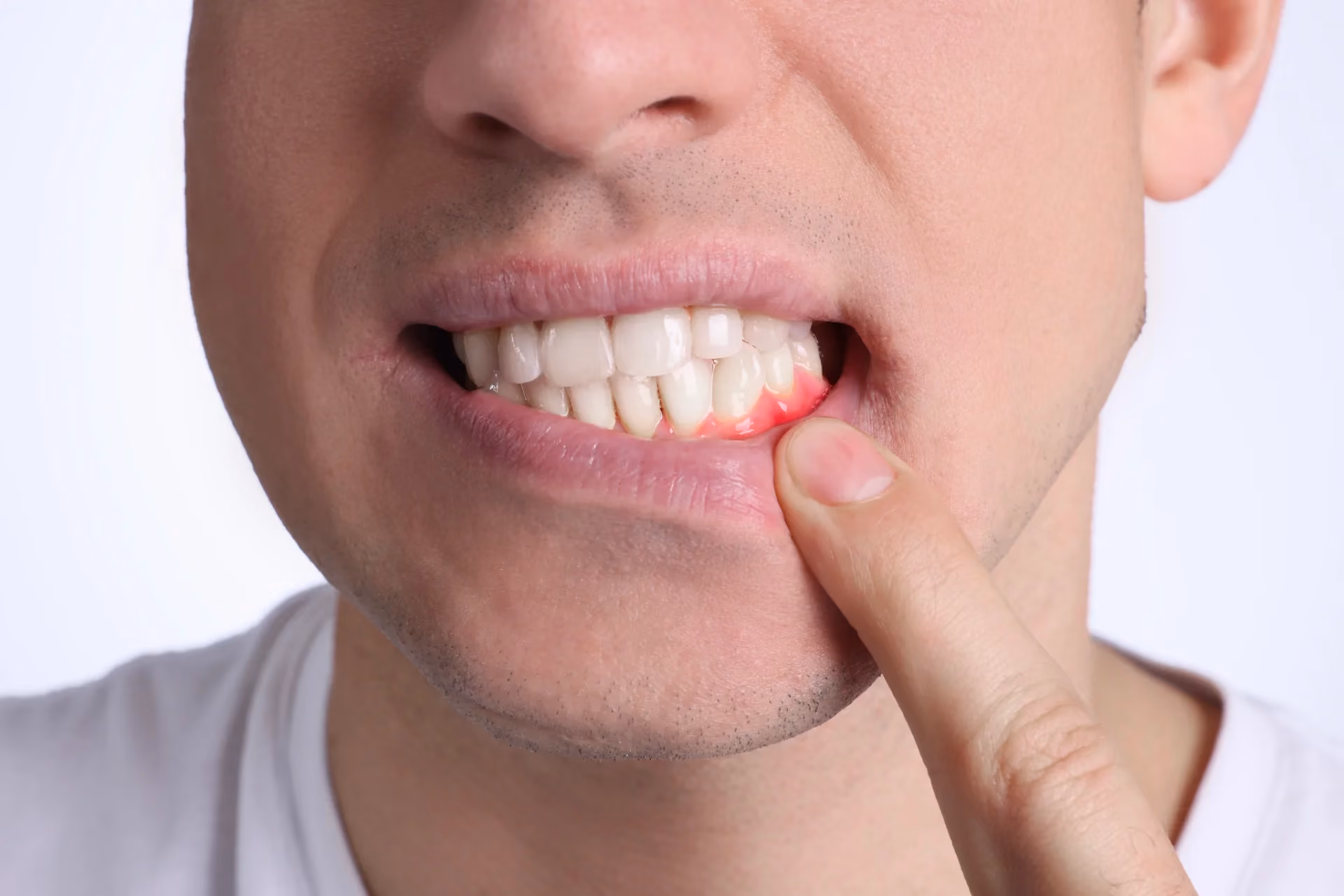 How Can I Defend Against Gum Recession?