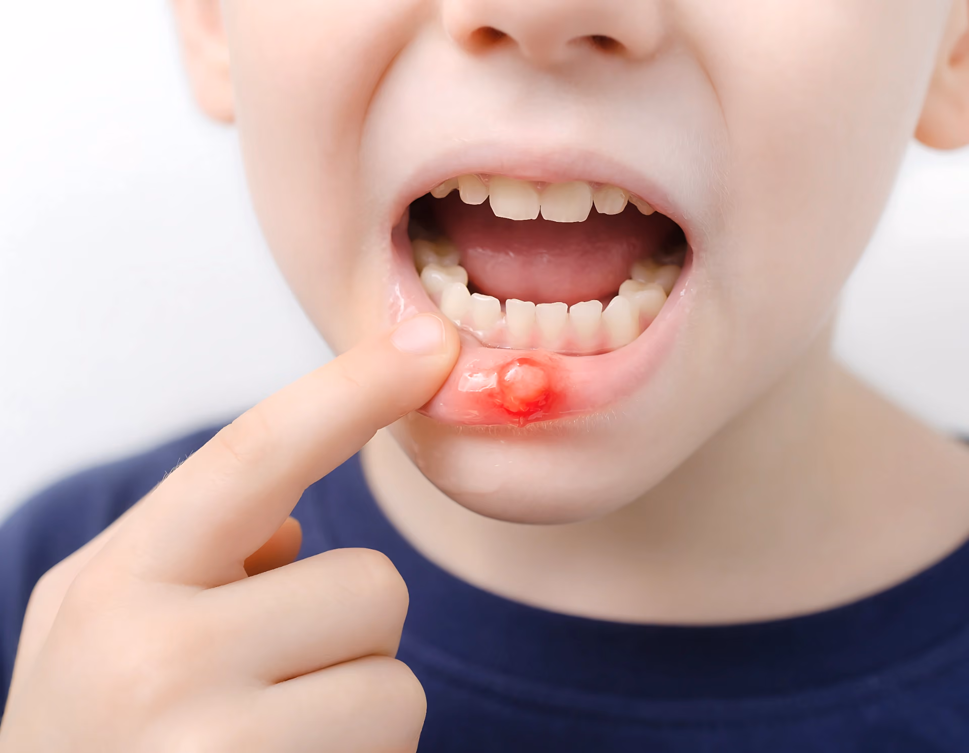 Canker Sores: Prevention, Causes, and Treatment