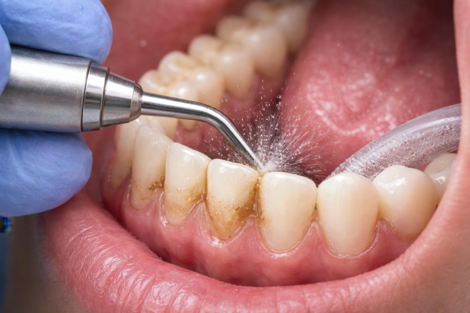 What Really Happens During a Dental Cleaning and Exam